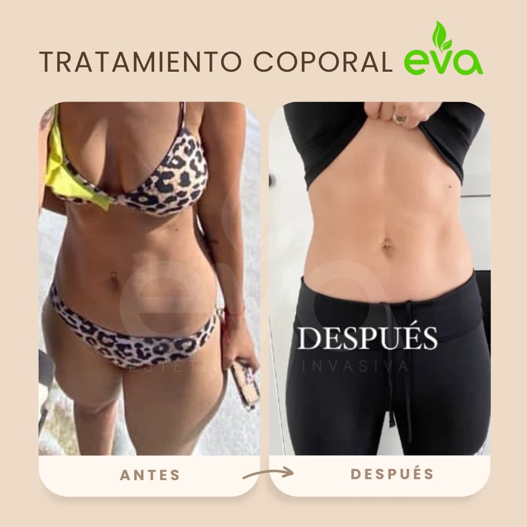 Antes y después reducción abdomen Lima – Siempre Eva