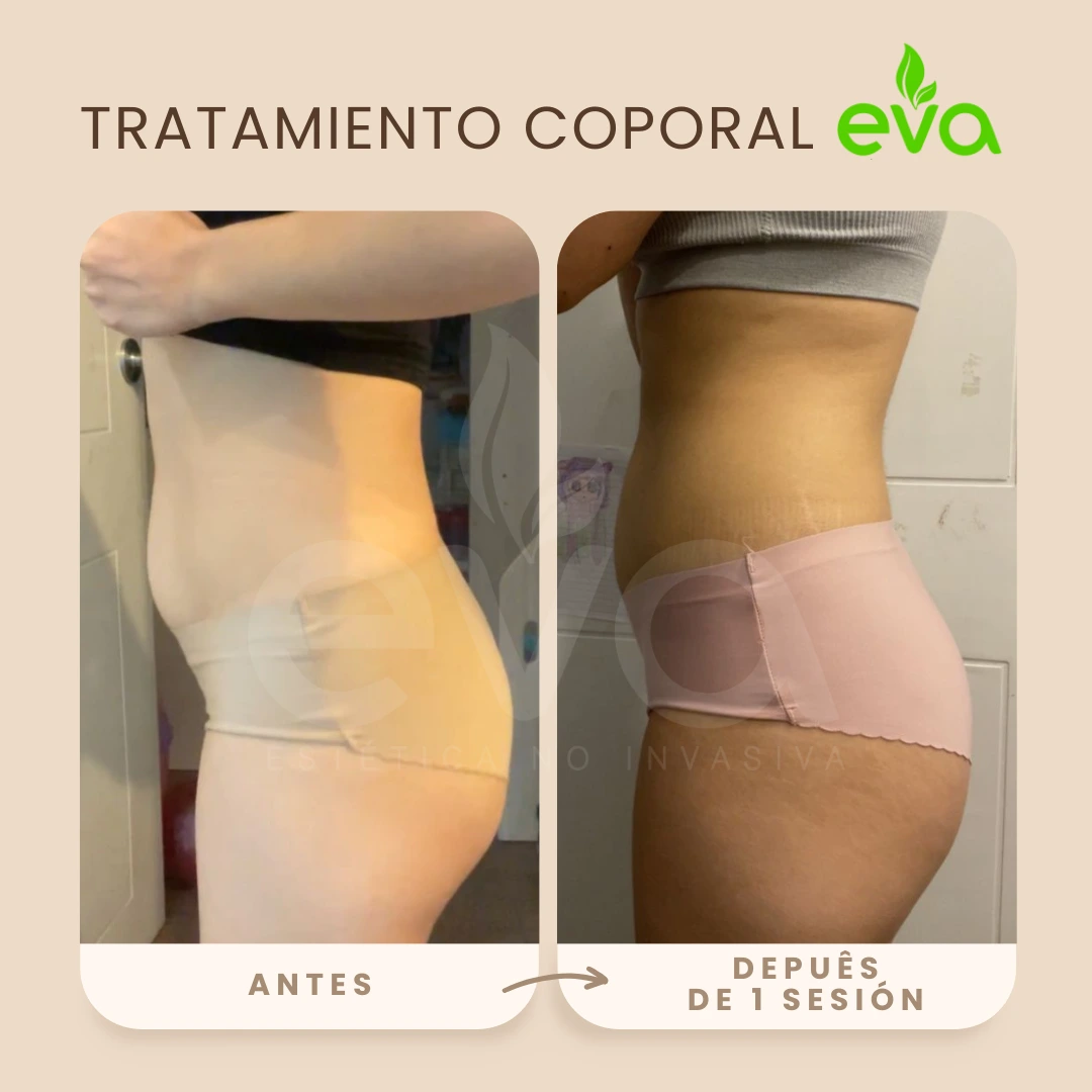 Antes y después glúteos Lima – Siempre Eva