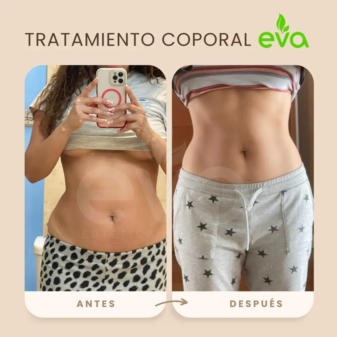 Antes y después reducción muslos Lima – Siempre Eva